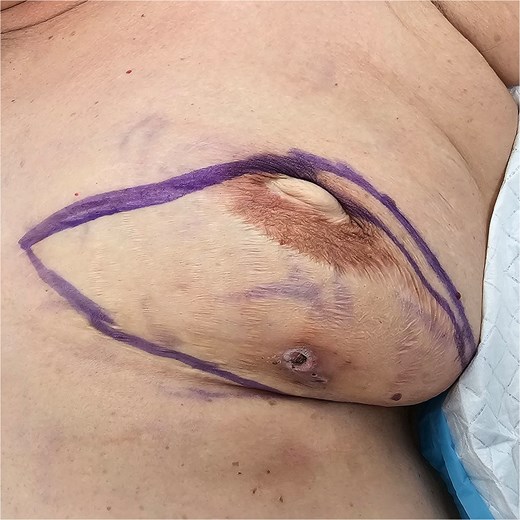 Preoperative picture of left breast.