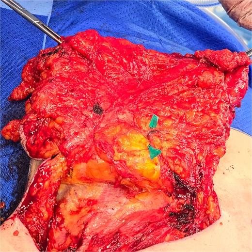 Transverse rectus abdominis myocutaneous (TRAM) flap.