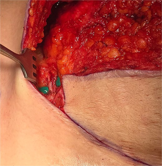 Superior epigastric paddle over the green contrast.