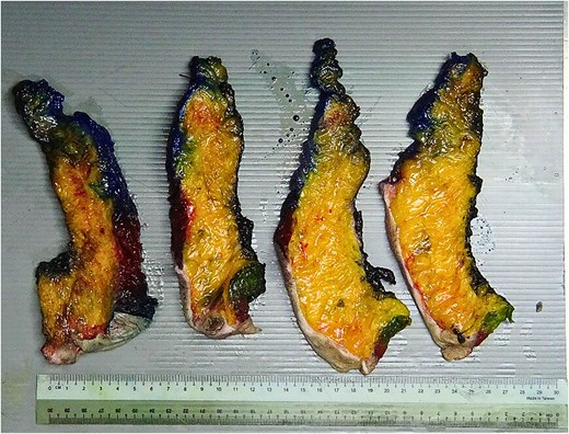 TRAM flap trimmed specimen, posterior margin labelled in black.