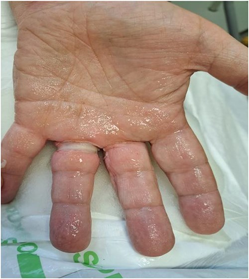 Volar view 90 min postinjury.