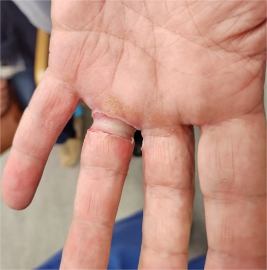 Volar view 4 h postinjury.