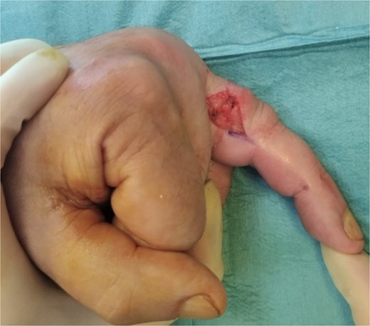 Intra-op radial incision.