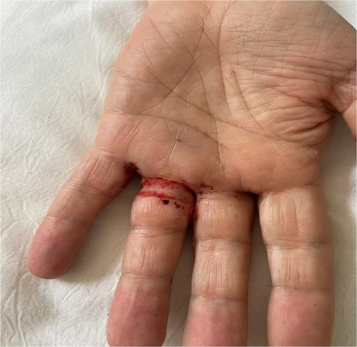 Day 3 postop. Volar view.