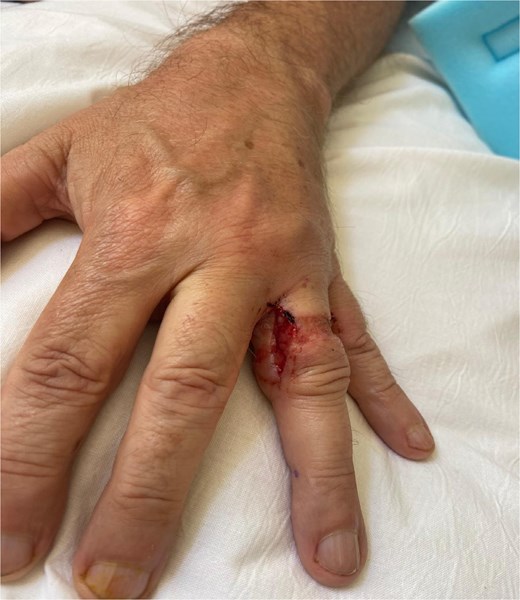 Day 3 postop. Radial incision.