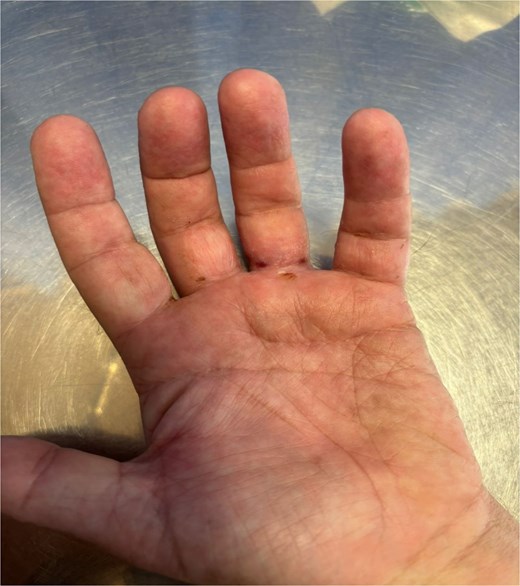 Volar aspect 3 months postsurgery.