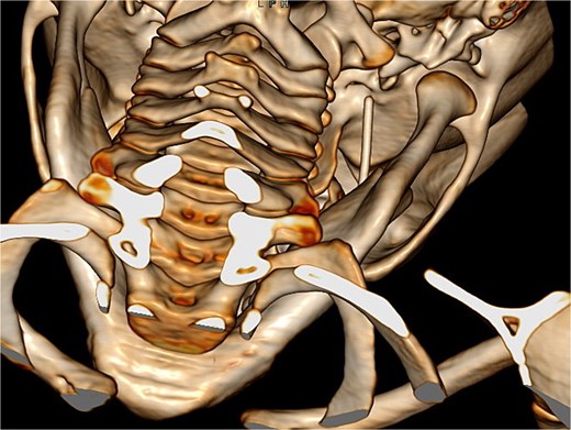 Diagnostic 3D CT showing the needle in the right pterygomandibular space.