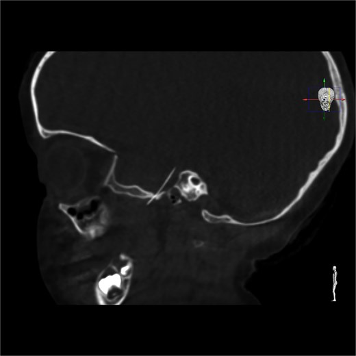 Intracranial CT scan showing the intracranial migration of the needle through the foramen ovale.