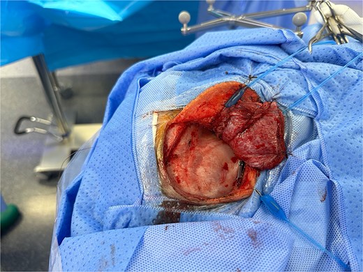 Pterional approach to reach the needle guided by neuronavigation.