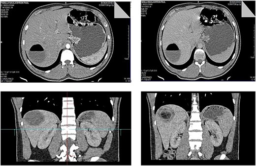 Contrast-enhanced abdominal CT showing a Gharbi type II hydatid cyst with an air-fluid level in segment VII of the liver, measuring approximately 5 cm in diameter.