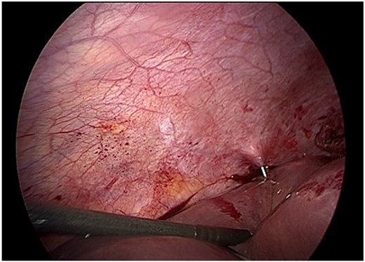 Intraoperative view of controlled puncture and aspiration of cyst contents. Gauze soaked in 17.7% hypertonic saline protects the operative field to prevent spillage.