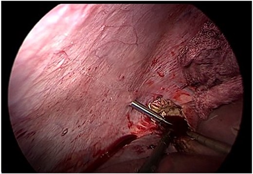 Endoscopic removal of the germinative membrane using an endobag through the 10 mm trocar. Inspection of the residual cavity was performed with a 30° laparoscope.