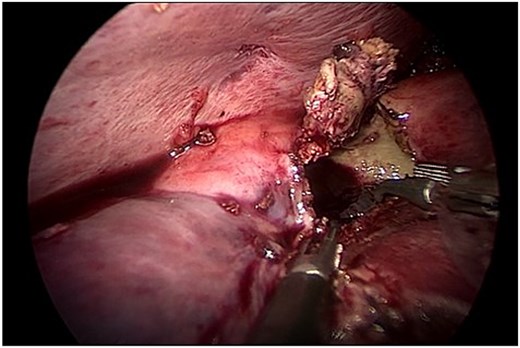 Careful evacuation of cystic material and limited resection of prominent pericystic tissue. Complete pericystectomy was not indicated due to cyst size and location.
