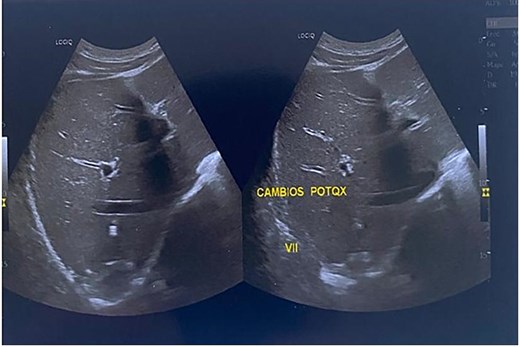 Three-month follow-up ultrasound showing small linear echogenic areas in segment VII, consistent with postsurgical changes. No anechoic or recurrent cystic areas were observed.