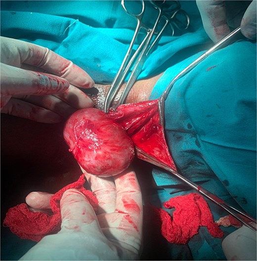 Enucleation of the clitoral cyst through midline incision made on the ventral surface.