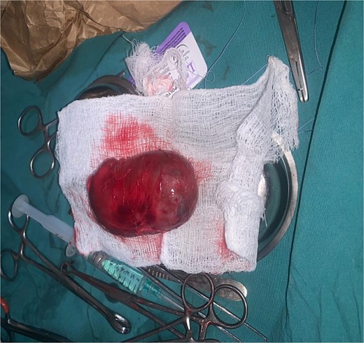 Enucleated cyst.