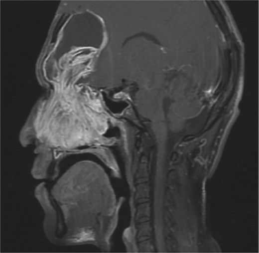 MRI sagittal view of the brain and sinuses showing mucopyoceles causing significant bilateral frontal sinus enlargement.