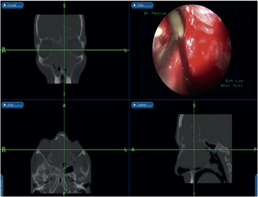 Bilateral frontal sinus showing infected nasal polyps, identified intraoperatively, and drained by image-guided endoscopic sinus surgery.