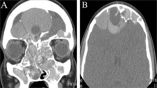 CT scan of paranasal sinuses in (A) coronal and (B) axial views, showing extensive disease with enlargement of sinuses, with more expansion of the right frontal sinus.