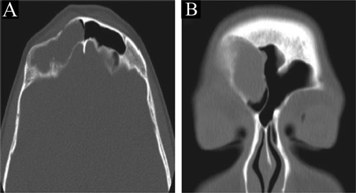 CT scan of the brain and paranasal sinuses in (A) axial and (B) coronal views, showing a lesion in the right frontal sinus with resorption of posterior and lateral walls. The anterior wall shows a depressed fracture.