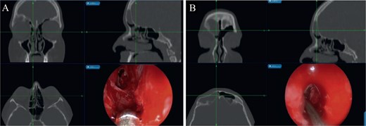 (A) Mucocele Draf IIa wide frontal sinusotomy, (B) image-guided wide marsupialization of mucocele.