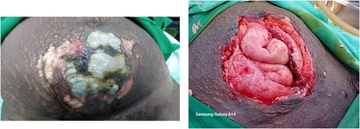 Case 1: Wound at presentation and after 4 days of continuous debridement.