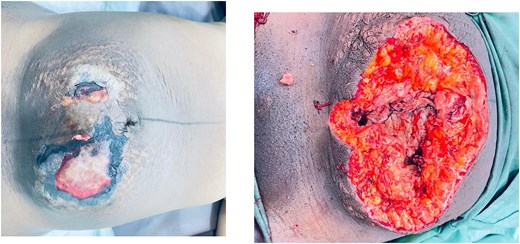Case 2: Anterior abdominal wall wound at presentation and following 3 days of continuous debridement.