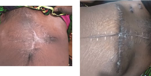 Case 1 (left) and 2 (right): Anterior abdominal walls of both patients 6 weeks after surgery.