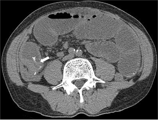 Preoperative CT revealed a high density area in the small intestine of the right lower abdomen, which was suspected to be a foreign body, and a circumferential wall thickening in the same area. The intestinal tract on the oral side of the area was dilated, and small intestinal obstruction due to chronic inflammation caused by the foreign body was suspected.