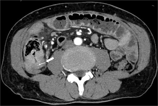 CT taken 3 months before surgery revealed a high-density area in the small intestine of the right lower abdomen that was thought to be a foreign body identical to the foreign body seen on the preoperative CT scan, as well as circumferential wall thickening.