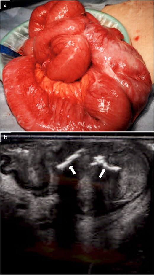The small intestines in the right lower abdomen were lumped together, and no lesions were exposed on the serosal surface (a). Intraoperative ultrasonography revealed a linear hyperechoic area in the mass that appeared to be a foreign body on CT (b).