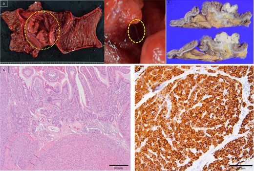 Specimen showed a type 2 tumor in the small intestine with a foreign body, such as a stuck wire (a). Pathological examination revealed that the tumor was predominantly located in the muscularis propria of the subserosa (b). Atypical cells existed in a pseudoglandular duct-like manner (c). Immunohistochemistry findings elucidated hepatocyte positive (d).
