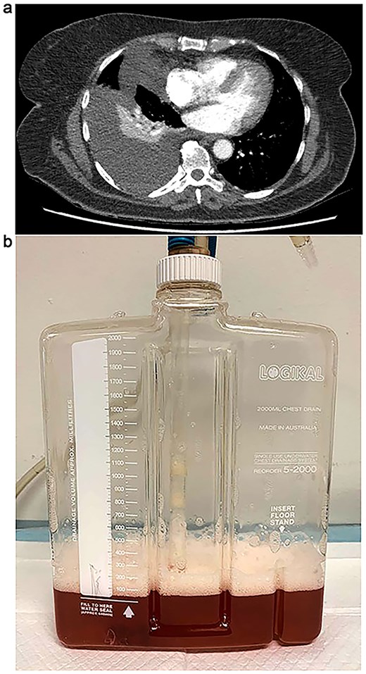 (a) CT chest demonstrating progressive large right-sided pleural effusion with new loculation and compressive right lower lobe collapse. (b) Bilious pleural fluid with froth following ultrasound guided intercostal pigtail catheter insertion.