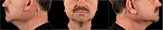 Six months post-operative photographs of the patient.