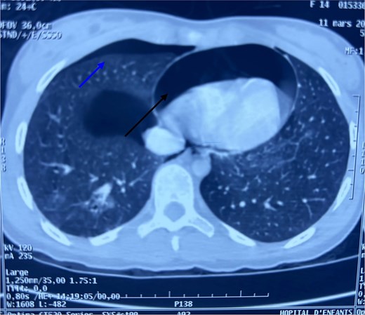 Axial chest CT scan showing pneumopericardium (lower arrow) and pneumothorax (upper arrow).