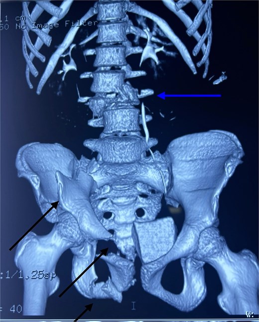 3D CT reconstruction showing L3 vertebral fracture (upper arrow) and multiple pelvic fractures (lower arrows).