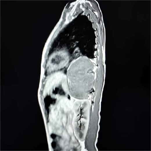 Sagittal contrast-enhanced CT scan showing a well-defined, homogeneous, soft-tissue mass (11 × 7 × 5 cm) in the left posterior mediastinum, abutting the descending aorta and thoracic vertebrae.