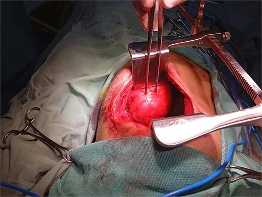 Intraoperative view during left posterolateral thoracotomy showing the encapsulated posterior mediastinal mass after exposure and mobilization.