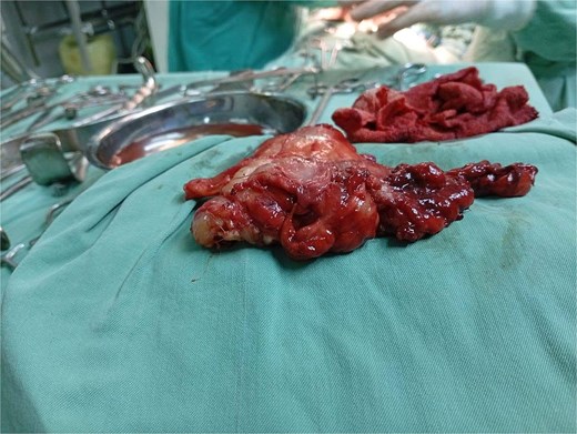 Gross intraoperative specimen of the posterior mediastinal mass following en bloc resection.
