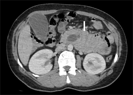 Axial contrast-enhanced CT image showing a duodenojejunal intussusception (arrow), originating from the fourth portion of the duodenum and involving invagination of a proximal jejunal loop.