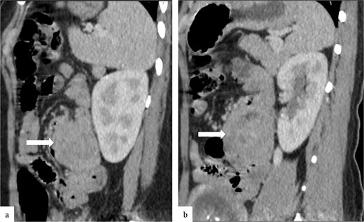 Sagittal contrast-enhanced CT images (a, b) showing the duodenojejunal intussusception with a pseudokidney appearance (arrows).