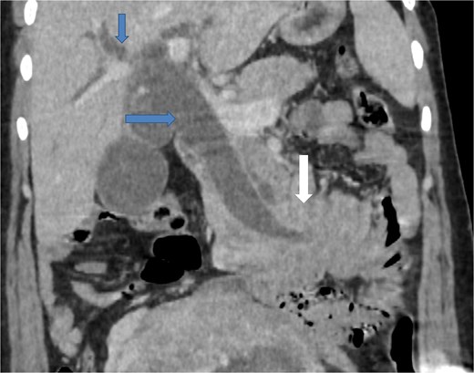Coronal contrast-enhanced CT image showing the intussusception causing traction on the distal common bile duct (arrow at the bottom), resulting in significant upstream dilatation of the extrahepatic and intrahepatic bile ducts (two arrows at the top).