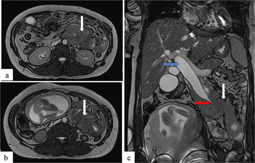 Axial (a, b) and coronal (c) T2-weighted TrueFISP MR images confirming the duodenojejunal intussusception (white arrows) and showing inclusion of the terminal bile duct within the intussuscepted segment (red arrow), resulting in significant upstream biliary dilatation (blue arrow).
