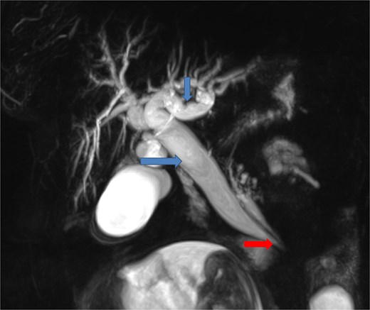 Coronal MR cholangiopancreatographic image showing an ectopic biliopancreatic confluence draining into the fourth portion of the duodenum (arrow at the bottom), which likely predisposed the biliary system to traction during the intussusception, resulting in upstream biliary duct dilatation (two arrows at the top).