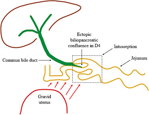 Illustration of the intussusception mechanism and biliary traction due to mechanical displacement from the gravid uterus and an ectopic biliopancreatic confluence in the fourth portion of the duodenum (D4).