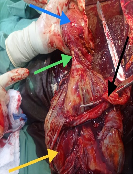Top left arrow – uterus, middle left arrow – point of attachment of placenta to annexe, bottom left arrow – placenta, middle right arrow – clamped cord.