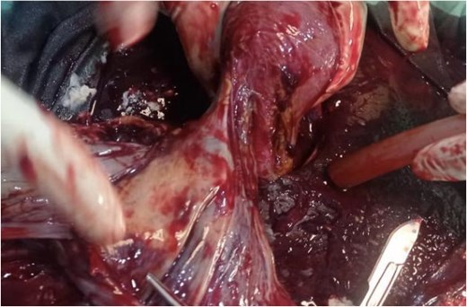 Point of attachment of placenta to adnexae.