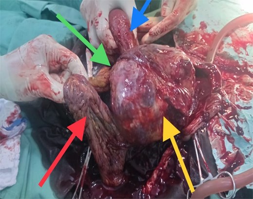 Top left arrow - omental adhesion, bottom left arrow - omentum, top right arrow - uterus, bottom right arrow - placenta.