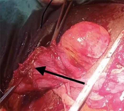 Arrow indicating the clamped and cut part of the adnaxae to which the placenta was attached.