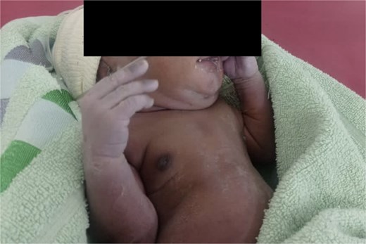Patient's baby at 21 days of age.